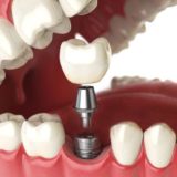 An Overview Of Dental Implants
